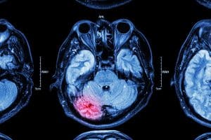 How Car Accidents Cause Brain Injury